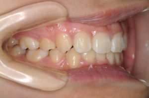 つくば・土浦の矯正歯科　つるみ矯正歯科　歯並び矯正症例B　叢生（乱杭歯）